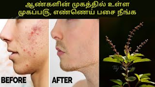 ஆண்களின் முகத்தில் உள்ள முகப்ப௫, எண்ணெய் பசை நீங்க... Pimples Removal || Pimples Pain Relief...