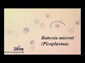 babesiosis