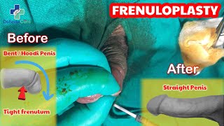 Short frenulum | Treatment | Tight foreskin | Frenuloplasty