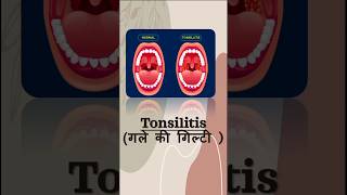 tonsilitis | cause | treatment | symptoms | गले मे सूजन होने का कारण |  #drugloft #information