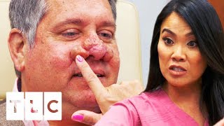Treating A SEVERE Case Of Rhinophyma | Dr. Pimple Popper