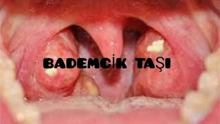 BADEMCİK TAŞI ÇIKARILMASI