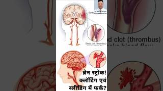 Brain stroke?Difference between Clotting and bleeding ब्रेन स्ट्रोक? क्लॉटिंग एवं ब्लीडिंग में फर्क