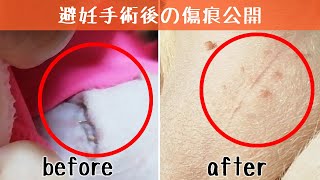 避妊手術後の傷口や抜糸後の傷痕を紹介【パグ子犬】