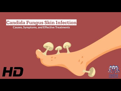 What causes fungal infections?