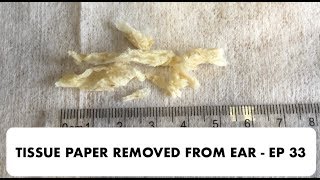 TISSUE PAPER REMOVED FROM EAR - EP 33