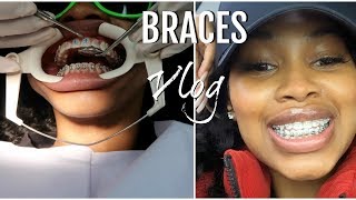 COME WITH ME TO GET BRACES! PAIN LEVEL & COPING WITH THEM THE FIRST FEW DAYS