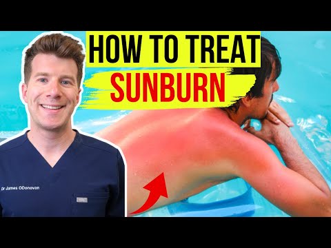 How long does sunburn take to fade?