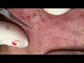 Deep Blackheads Removal from Cheeks and Nose Best Pimple Popping Videos