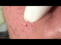 Deep Blackheads Removal from Cheeks and Nose Best Pimple Popping Videos