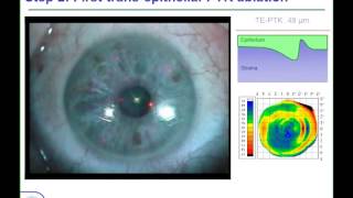 LoVC Course on Therapeutic Corneal Refractive Surgery Part 4 (of 6): Irregular Astigmatism