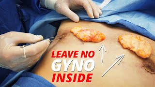 Specialized Gyno Surgery Using Internal Flaps - Get ALL The Gland Out