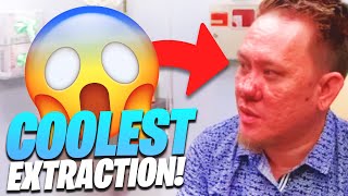 SUPER COOL Extractions On Dr. Pimple Popper