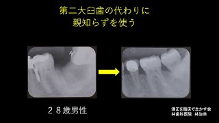 下顎第２大臼歯の代わりに親知らずを使う。親知らずは時として役に立つ時があります。