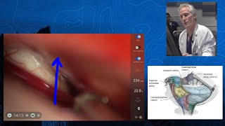 Episode 3: Performance - Pontomesencephalic Cavernous Malformation