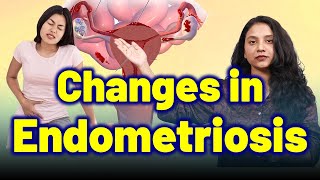 Changes in Endometriosis . | Treatment \u0026 cure  | Homeopathy, Medicine \u0026 Surgery