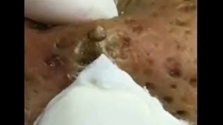 Big blackheads removing - blackheads​​ - whiteheads 2019