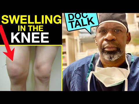 What causes swelling and suprapatellar effusion in the knee?