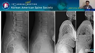 17   How to Avoid Creating Deformity as Spine Surgeons   Raymond J  Hah, MD