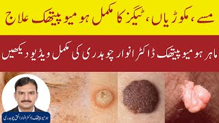 Homeopathic Treatment For Warts, Skin Tags, Moles, Age Spots, Oil Clogs | Homeopathic Doctor