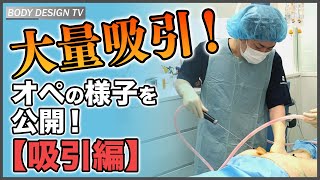 【脂肪吸引編】手術って具体的には何をしてるの？｜vol.432【ボディデザインTV】