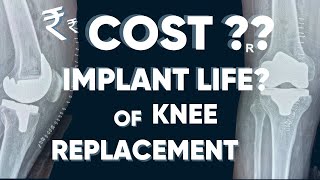 Cost of Knee Replacement in India ? || Lifespan of knee replacement Implant in Life Years