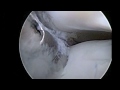 arthroscopic fragment fixation for elbow ocd　　肘離断性骨軟骨炎の関節鏡視下固定術