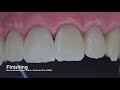 eng anterior restoration with fgm composites