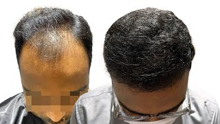 Grade 4 & Crown Pattern Baldness | Best Hair Transplant In Nashik |