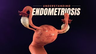Endometriosis - Is it a serious problem? | Main Causes - 3D Video