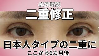 ものすごく濃い二重から、日本人タイプの正常な二重に変えました。腱膜固定と吊り上げをしています。