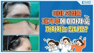 #이마보형물 제거하고 이마가 푹 꺼지면 어쩌죠?😧 #이마재수