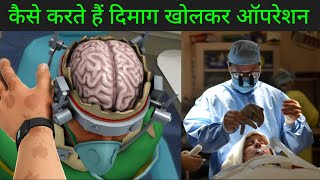 देखिए खोपड़ी उतारके दिमाग का ऑपरेशन कैसे करते हैं डॉक्टर | How Does Human Brain Surgery Works