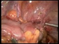 Laparoscopic Repair of a Colo Vesical Fistula