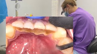 Tartar removal / dental cleaning / scaling