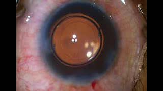 Beautiful Phacoemulsification in Extreme high myopia with DEEP anterior chamber in ONE EYED  Patient