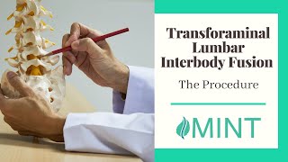 Transforaminal Lumbar Interbody Fusion Plano TX: The Procedure – Dr. Scott Kutz | (972) 244-3491