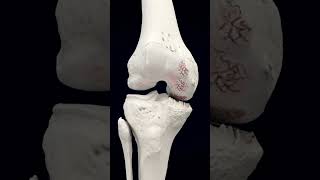Visco-gel injections for knee arthritis pain