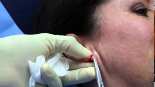 Torn earlobe repair in 15 minutes -- 13 second video!
