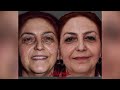 dr. nüket eroğlu 3d babyface