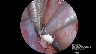 Trigeminal Neuralgia Minimally Invasive Surgery