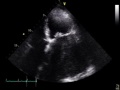 4d. chronic lv dysfunction compare with 4a e winfocus cc echo course by gabriele via