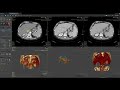 Vitrea Demonstrations  |  Liver Resection Planning