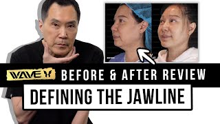 Face Lift Before & After Review: How to Tighten the Jawline and look Natural | Wave Plastic Surgery