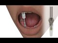 teethxpress immediate load conversion technique