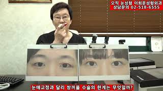 쌍꺼풀수술로 어디까지 눈이 커질수 있을까