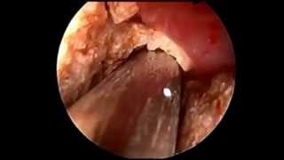 PCNL - Percutaneous Nephrolithotomy