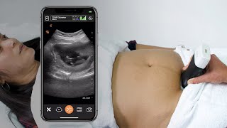 First Trimester Intrauterine Pregnancy: Ultrasound Scanning Technique