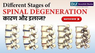 Different Stages of Spinal Degeneration | Degenerative Disc Disease Treatment In India -Dr Devashish