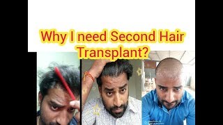 Why I need second Hair Transplant? Tamil Hair Transplant